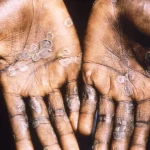 monkeypox